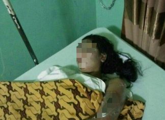 Korban M Masih Terbaring Di Rumah Sakit Kesrem Lhokseumawe